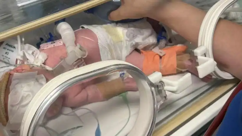 Ιατρική επιτυχία στη Λάρισα: Σώθηκε μωρό μόλις 600 γραμμαρίων με πρόβλημα στο μάτι (βίντεο)
